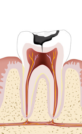 Wurzelkanalbehandlung Endodontologie Sagadent Ihr Zahnarzt In M Nchen