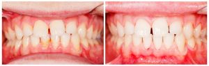 Vorher-Nachher-Vergleich von menschlichen Zähnen. Links sind die Zähne uneben und weisen Zahnsteinablagerungen auf. Rechts sind die Zähne weiß, glatt und gleichmäßig nach einem zahnärztlichen Eingriff. Das Zahnfleisch wirkt auf beiden Bildern gereizt.