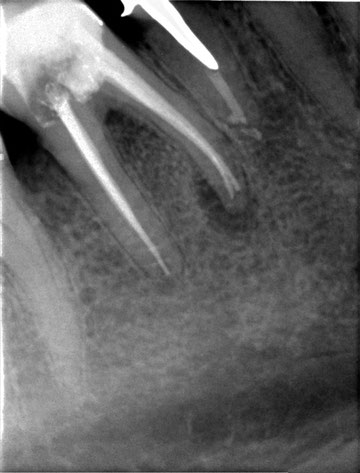 Ein Röntgenbild eines Zahns mit sichtbaren Wurzelkanälen. Die Wurzeln des Zahns sind klar erkennbar und zeigen möglicherweise Anzeichen einer Wurzelbehandlung oder eines zahnmedizinischen Eingriffs. Die umliegenden Strukturen des Kieferknochens sind ebenfalls sichtbar.