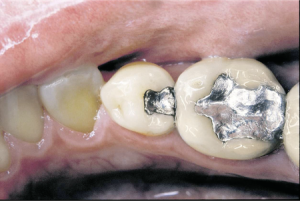 Nahaufnahme von menschlichen Backenzähnen, davon einer mit einer großen Silberamalgamfüllung. Die Zahnstruktur weist Abnutzungsspuren und Verfärbungen auf. Das Zahnfleisch erscheint gesund, zeigt aber leichte Schwellung. Die Zähne sind teilweise miteinander in Kontakt.