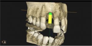 3D-Darstellung eines menschlichen Schädels mit Fokus auf die Zähne. Ein gelber Zylinder ist in der Mitte des oberen Kiefers sichtbar, möglicherweise als Markierung oder Implantat angezeigt. Das Bild zeigt Knochenstrukturen und Zahnpositionen deutlich.