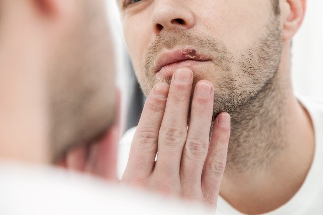 Ein Mann schaut in einen Spiegel und berührt seine Lippen mit den Fingern. Auf seiner Oberlippe ist eine Fieberblase sichtbar. Der Mann hat hellbraune Haare und trägt ein weißes Shirt. Die Szene spielt sich in einem hellen Raum ab.